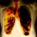 El cáncer de pulmón ha matado a 370.000 españoles en dos décadas